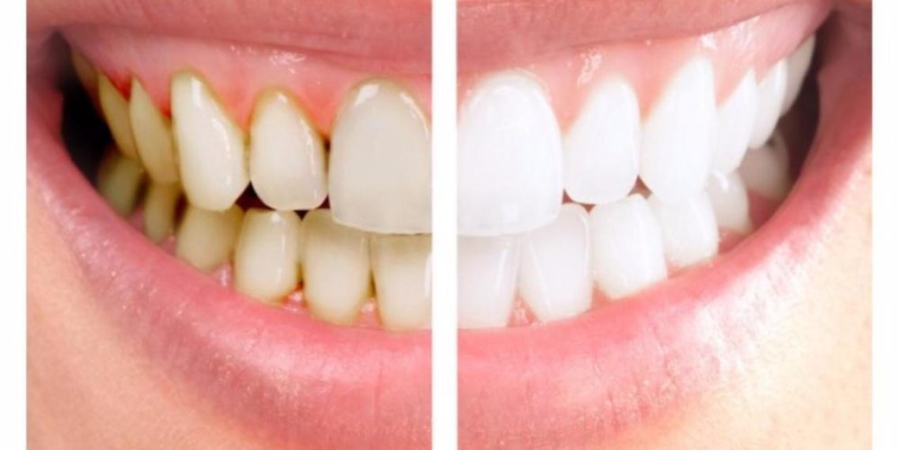 061119071724DentalScaling 061119071724DentalScaling